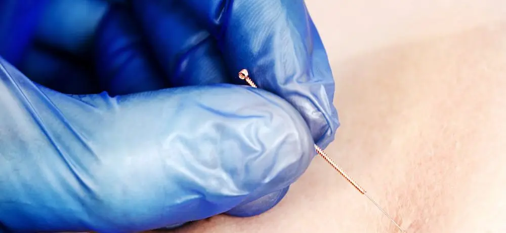 Dry Needling – Poncture sèche