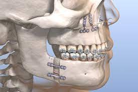 Chirurgie orthognatique Rééducation Maxillo-Faciale