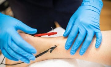 dry needling