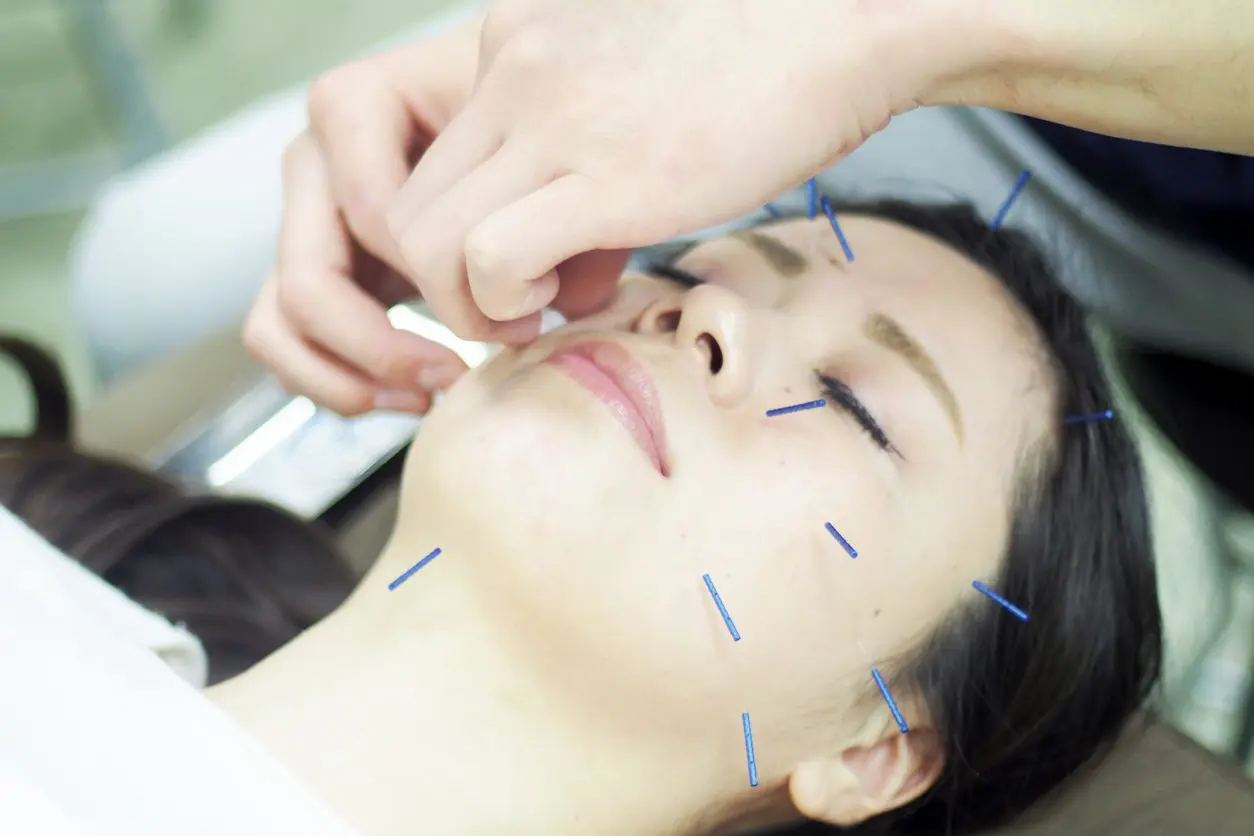 L’efficacité du dry needling pour les patients souffrant de douleurs orofaciales associées à un dysfonctionnement temporomandibulaire : examen systématique et méta-analyse