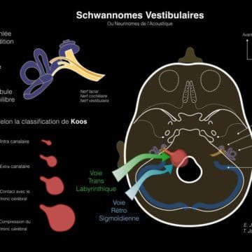 Schwannome Vestibulaire