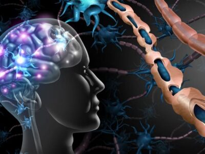 Multiple Sclerosis Nerve Disorder