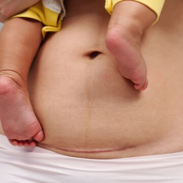 kinesitherapie-cesarienne-formation-kine-lorraine-nancy