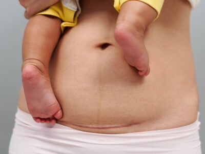 kinesitherapie-cesarienne-formation-kine-lorraine-nancy