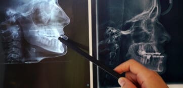Progrès des biomatériaux dérivés de cellules souches adipeuses dans la régénération maxillofaciale