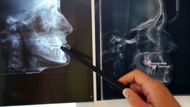 CT scans of teeth before and after orthodontic treatment. preparation for maxillofacial surgery. High quality photo