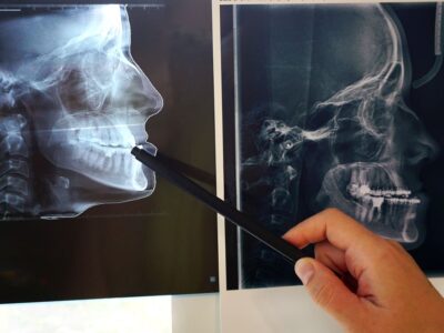CT scans of teeth before and after orthodontic treatment. preparation for maxillofacial surgery. High quality photo