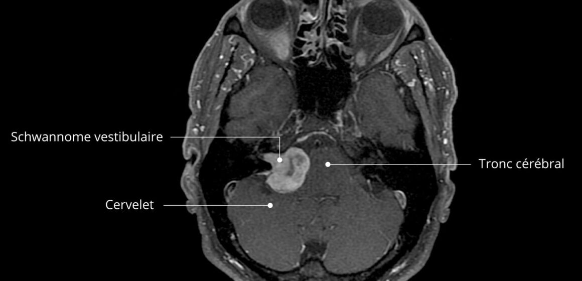 Vestibularisschwannom-MRI-fr