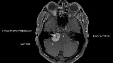 Vestibularisschwannom-MRI-fr
