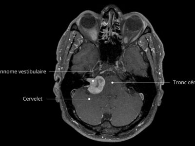 Vestibularisschwannom-MRI-fr