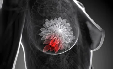 Kinésithérapie du cancer du sein : renforcement musculaire supervisé après les traitements
