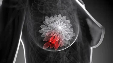 Kinésithérapie du cancer du sein : renforcement musculaire supervisé après les traitements