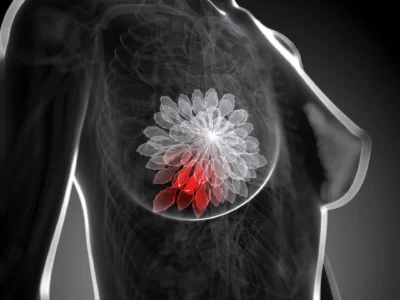 Kinésithérapie du cancer du sein : renforcement musculaire supervisé après les traitements
